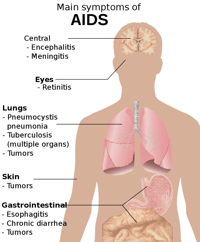 Main symptoms of AIDS / Häggström, Mikael (2014). “Medical gallery of Mikael Häggström 2014”. WikiJournal of Medicine 1 (2). ISSN 2002-4436. Public Domain.