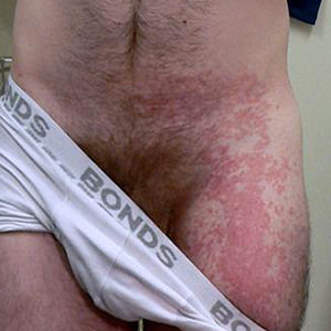 Human Immunodeficiency Virus / STI Atlas
