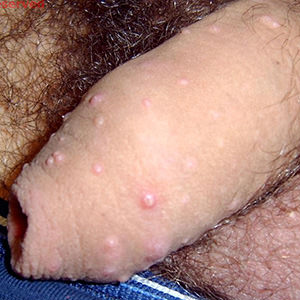 Molluscum Contagiosum / STI Atlas