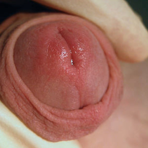 Non-specific Urethritis / STI Atlas