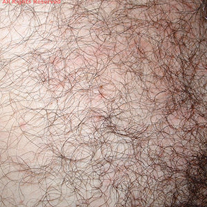 Pubic Lice / STI Atlas